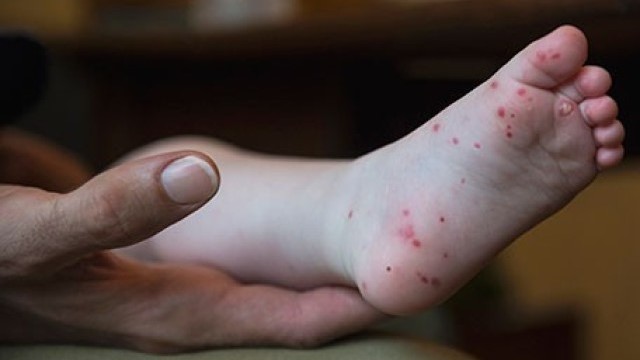 A parent holding a child's foot, which has a rash on it