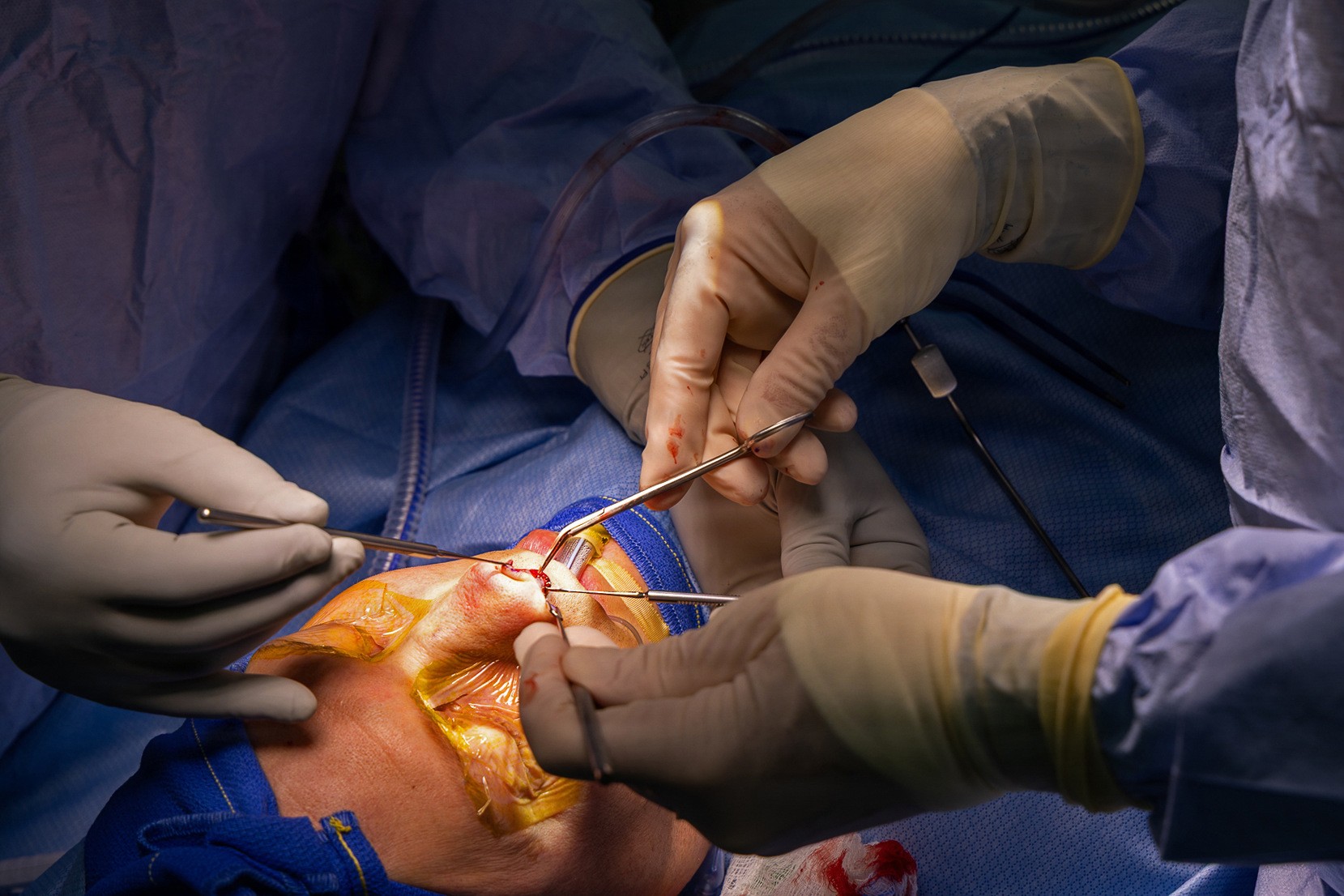 Maxillofacial Restoration